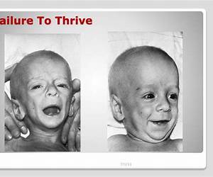 Failure to Thrive Failure to Thrive