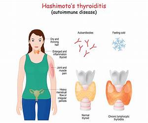 Hashimotos Thyroiditis: Lifestyle Interventions for Finding and Treating the Root Cause